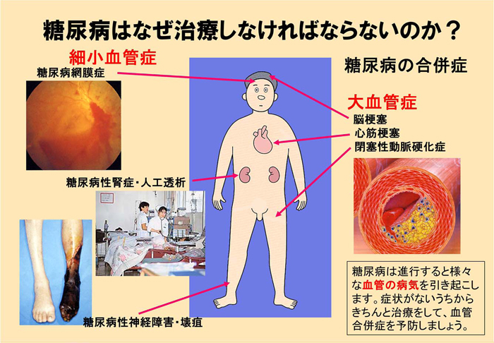 糖尿病はなぜ治療しなければならないのか？　糖尿病は進行すると様々な血管の病気を引き起こします。症状がないうちからきちんと治療をして、血管合併症を予防しましょう。