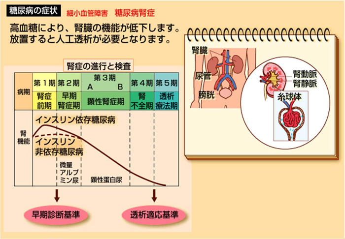 細小血管障害　糖尿病腎症　高血糖により、腎臓の機能が低下します。放置すると人工透析が必要となります。