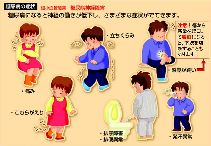 細小血管障害　糖尿病神経障害　糖尿病になると神経の働きが低下し、さまざまな症状がでてきます。注意！傷から感染を起こして壊疽になると下肢を切断することもあります！　・発汗異常